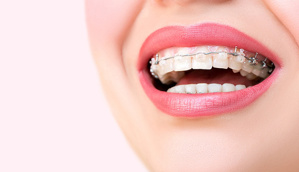 Types of Braces - McMillian Orthodontics